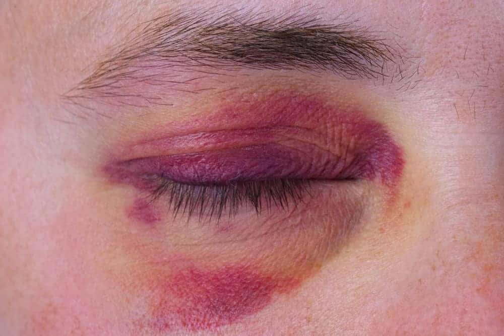 Como Se Livrar De Hematomas Ou Hematomas Nos Olhos 